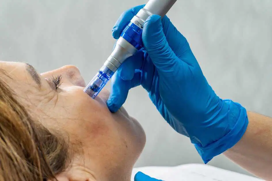 The Benefits of SkinPen Microneedling for Acne Scars in Flower Mound, TX at SpaVela